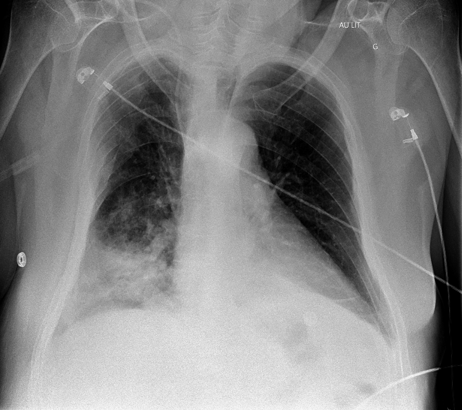 Radiographie thoracique de face au lit d'une patiente porteuse d'un cathéter veineux central