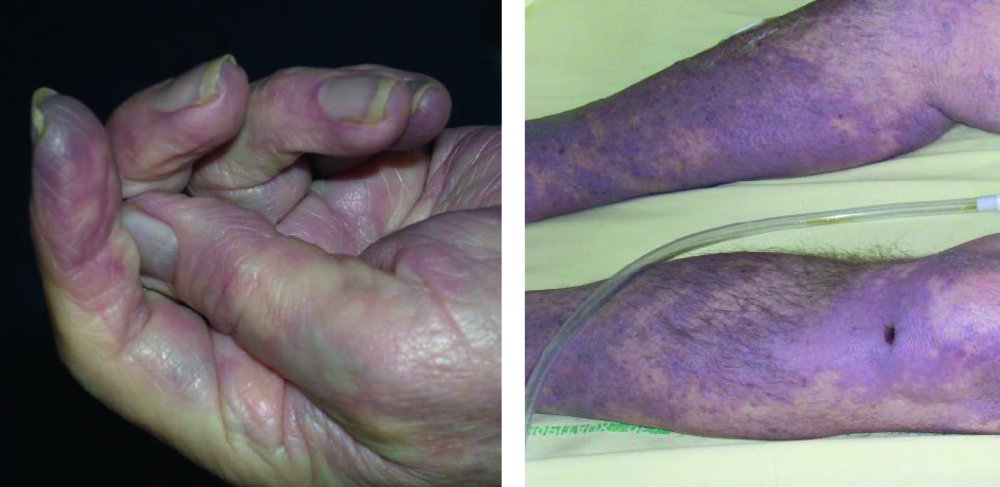 A Lésions purpuriques plus ou moins extensives chez deux patients atteints de purpura fulminans