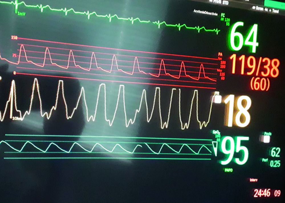 Photographie d'un scope de surveillance avec tracés ECG, pression artérielle, courbes respiratoires et valeurs numériques