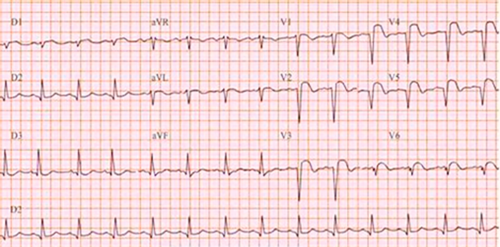 ECG 12 dérivations du patient