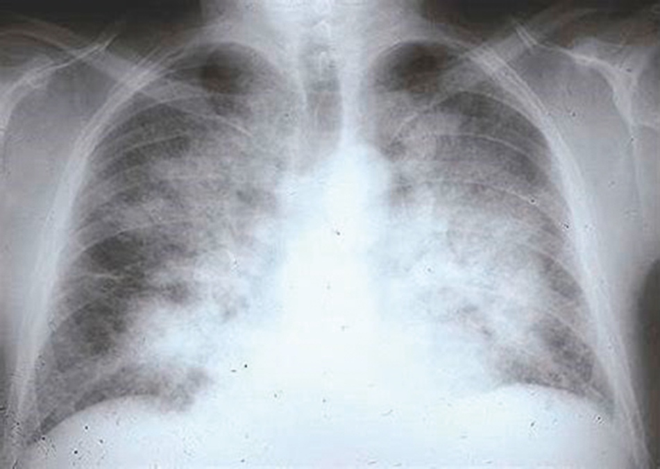 Radiographie thoracique de face du patient réalisée en urgence