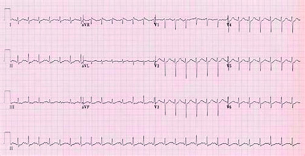 ECG 12 dérivations du patient, réalisé à l'examen initial