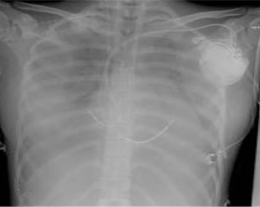 Radiographie thoracique de face d'un patient avec dispositif implanté sous la clavicule gauche et sondes