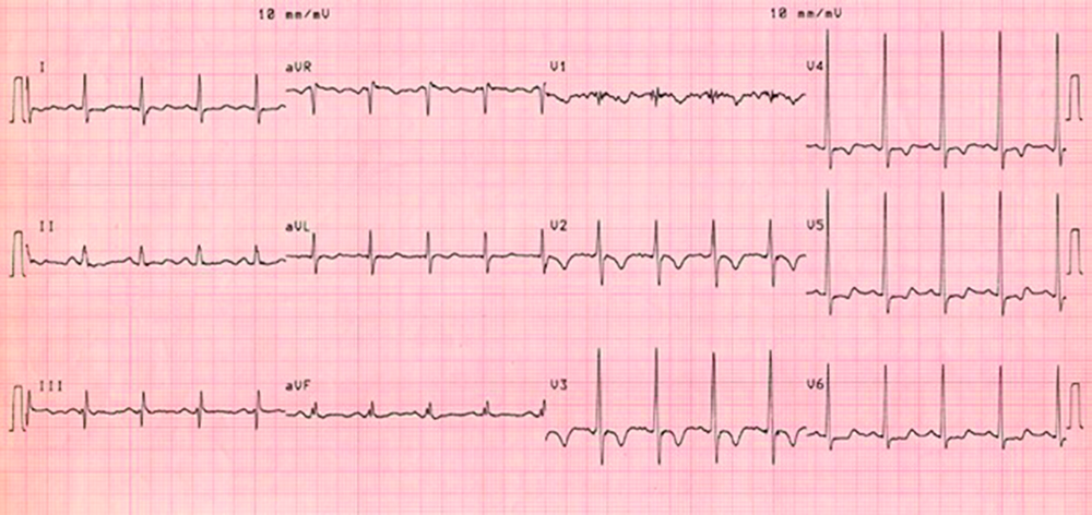ECG 12 dérivations initial du patient