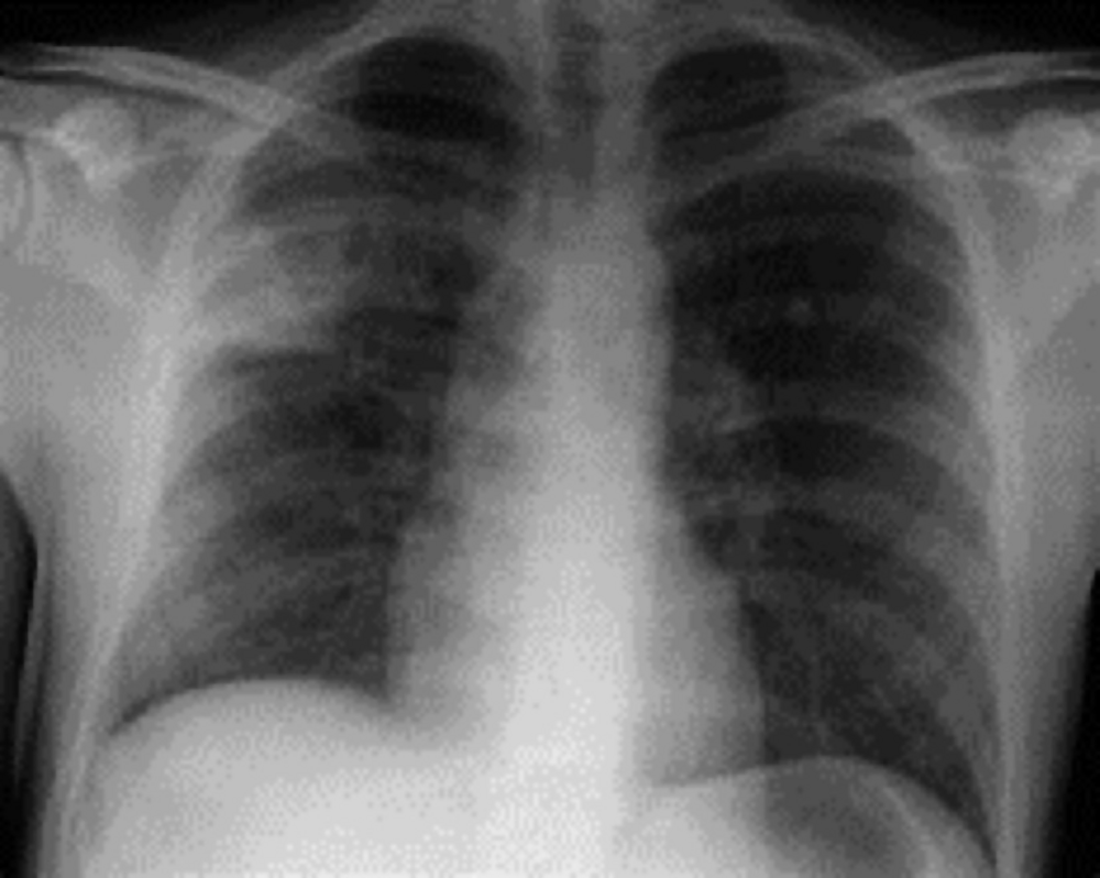 Radiographie thoracique de face du patient réalisée aux examens initiaux