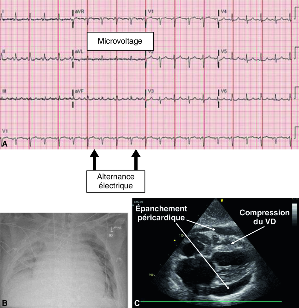 A C L’échographie fait le diagnostic