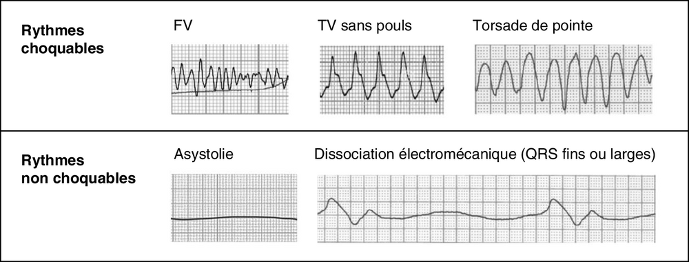 B Recommandations de prise en charge avancée d’un arrêt cardiocirculatoire de l’adulte