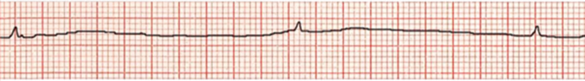 Tracé ECG sur le moniteur du défibrillateur semi-automatique à l'arrivée du réanimateur