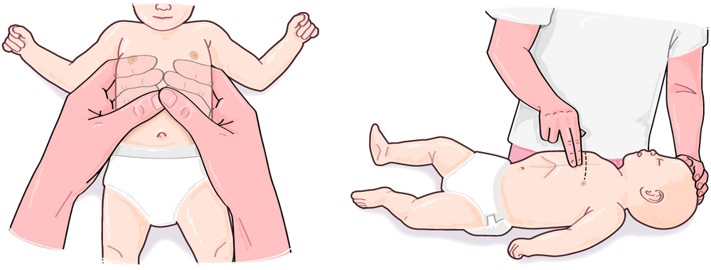 A Technique de massage cardiaque externe chez le nourrisson et jusqu’à l’âge de 1 an
