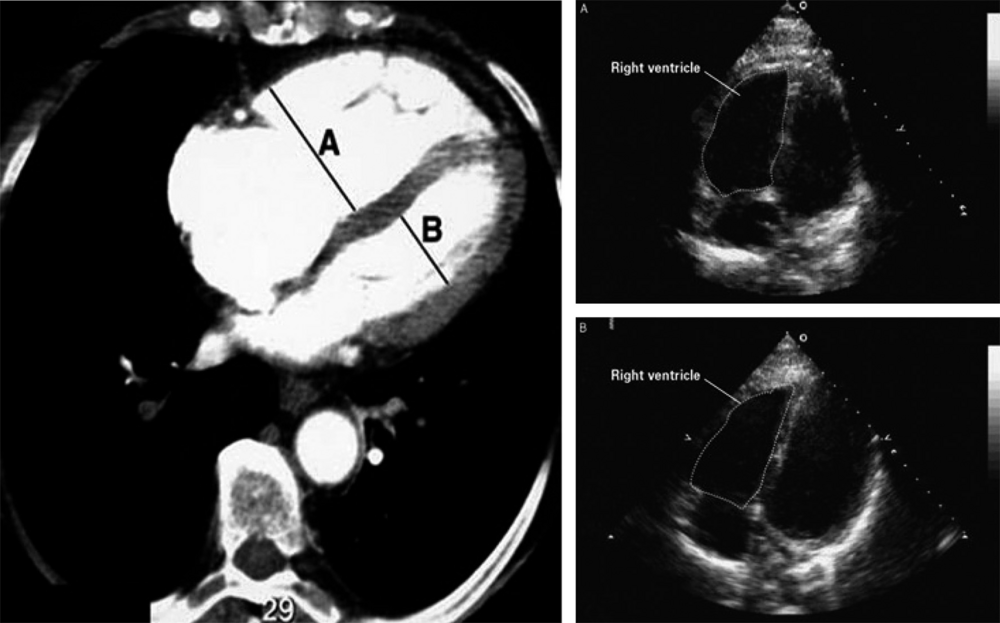 A Signes de dysfonction ventriculaire droite en échographie et à l’angioscanner