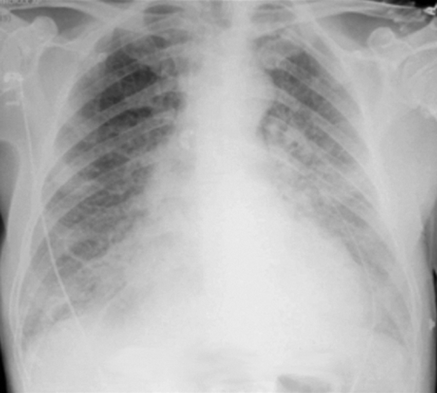 Radiographie thoracique de face du patient réalisée aux examens initiaux