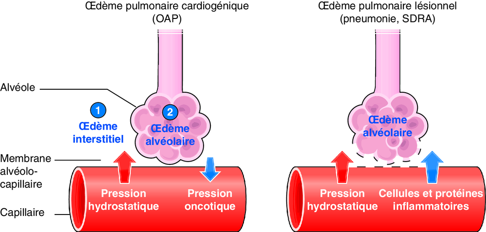 B Physiopathologie de l’œdème aigu pulmonaire cardiogénique et de l’œdème aigu pulmonaire lésionnel