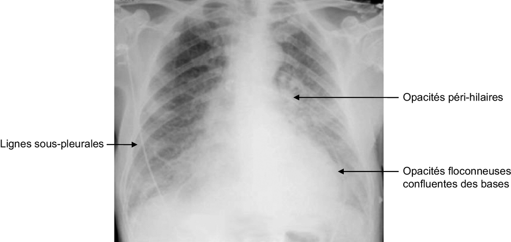 A Œdème aigu pulmonaire cardiogénique. Radiographie de thorax