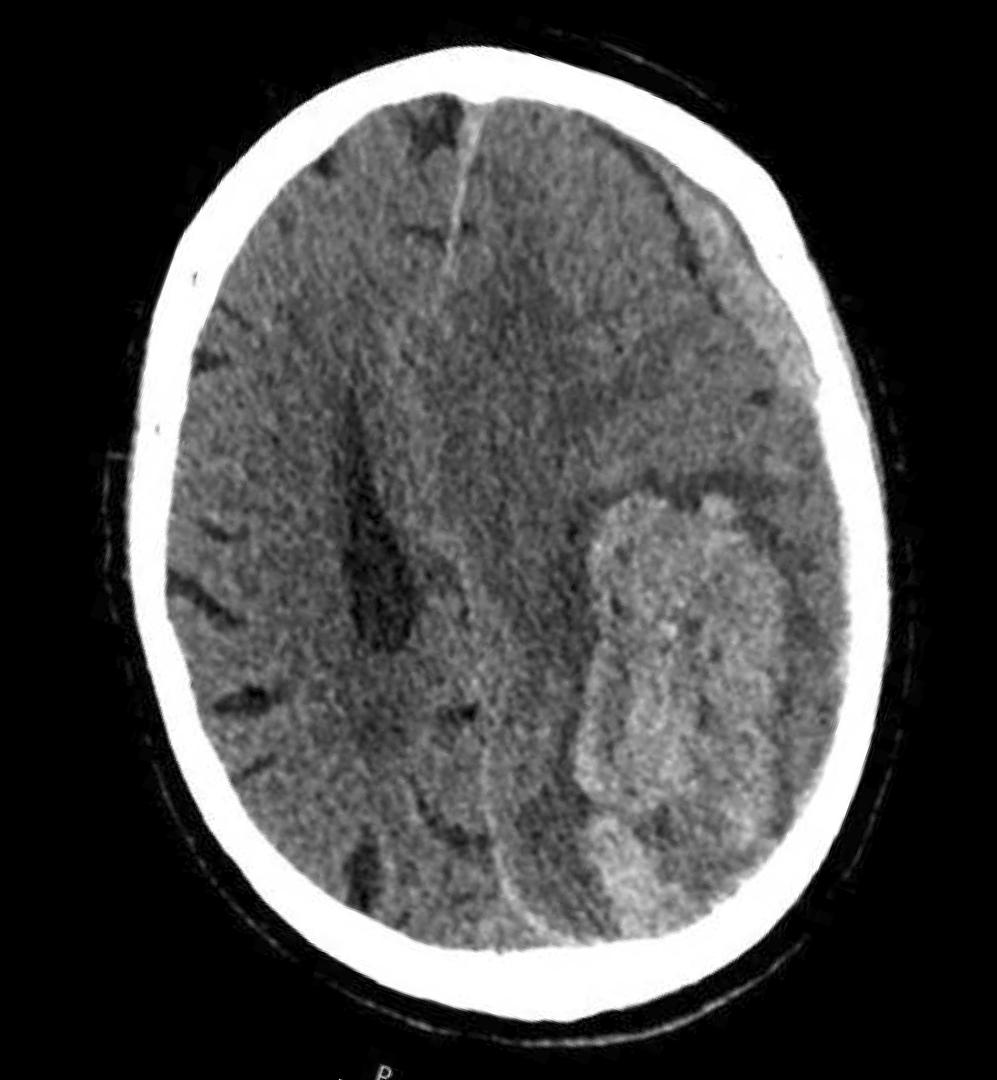 Coupe de scanner cérébral sans injection, réalisée devant une confusion avec hypertension artérielle