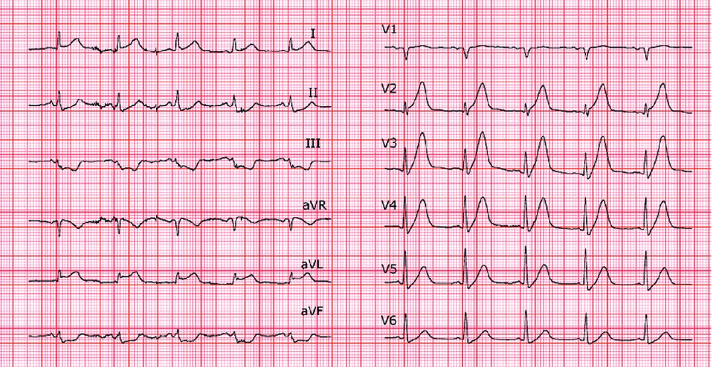 ECG 12 dérivations réalisé en urgence chez le patient