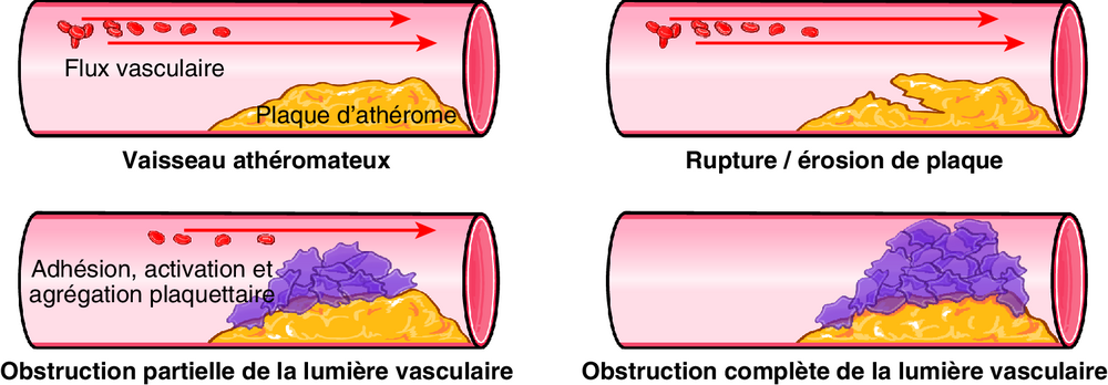 B Physiopathologie du SCA