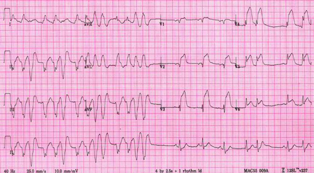 ECG 12 dérivations réalisé après les chocs électriques externes