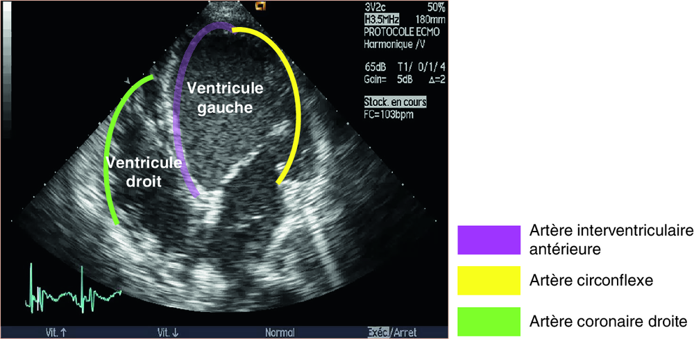 A Topographie coronaire : coupe échocardiographique apicale « quatre cavités »