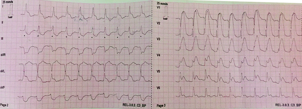 ECG 12 dérivations du patient