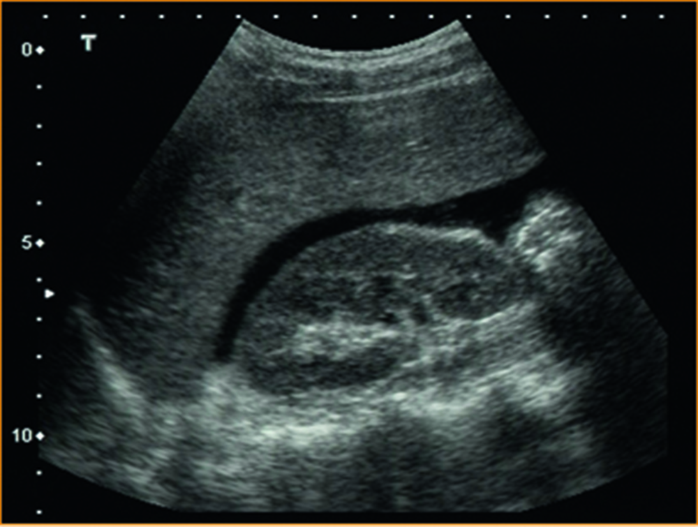 Image d'échographie abdominale réalisée à l'arrivée du patient