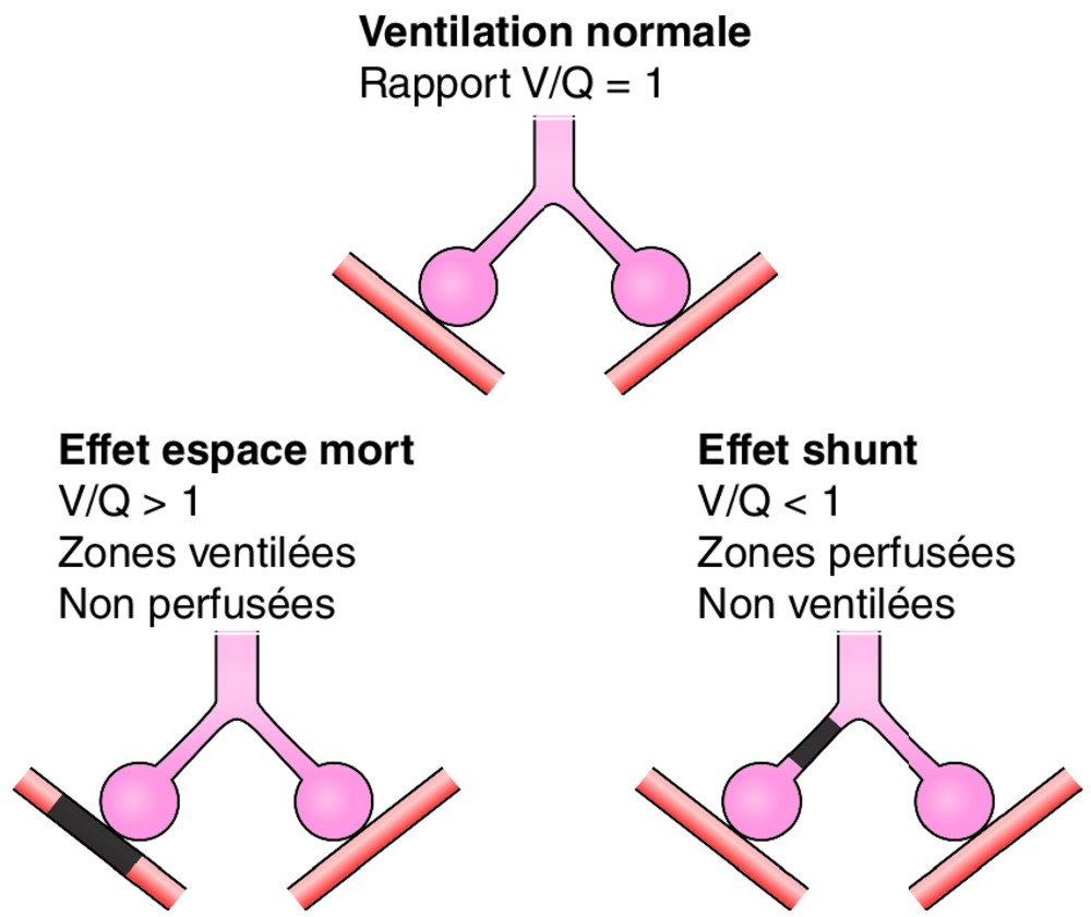 B Rapports ventilation/perfusion