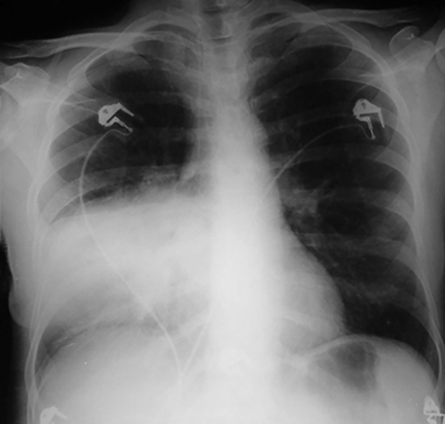 Radiographie thoracique de face du patient réalisée aux examens initiaux