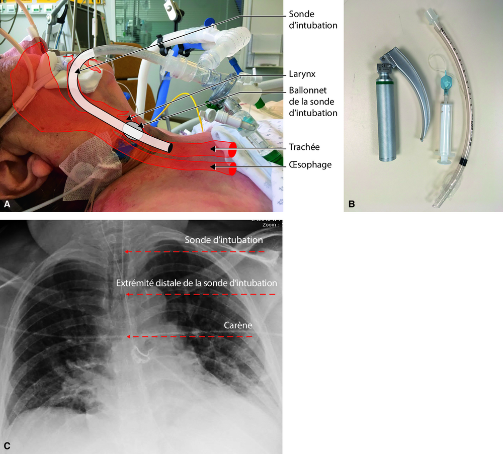 B Intubation orotrachéale d’urgence (IOT)