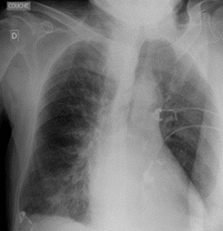 Radiographie thoracique de face du patient