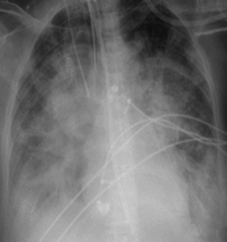 Radiographie thoracique de face du patient, avec sondes et dispositifs de monitorage