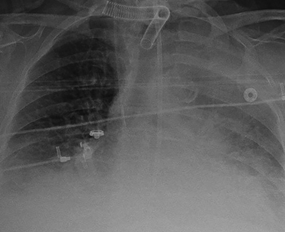 Radiographie thoracique de face au lit d'un patient trachéotomisé, support d'une question de repérage