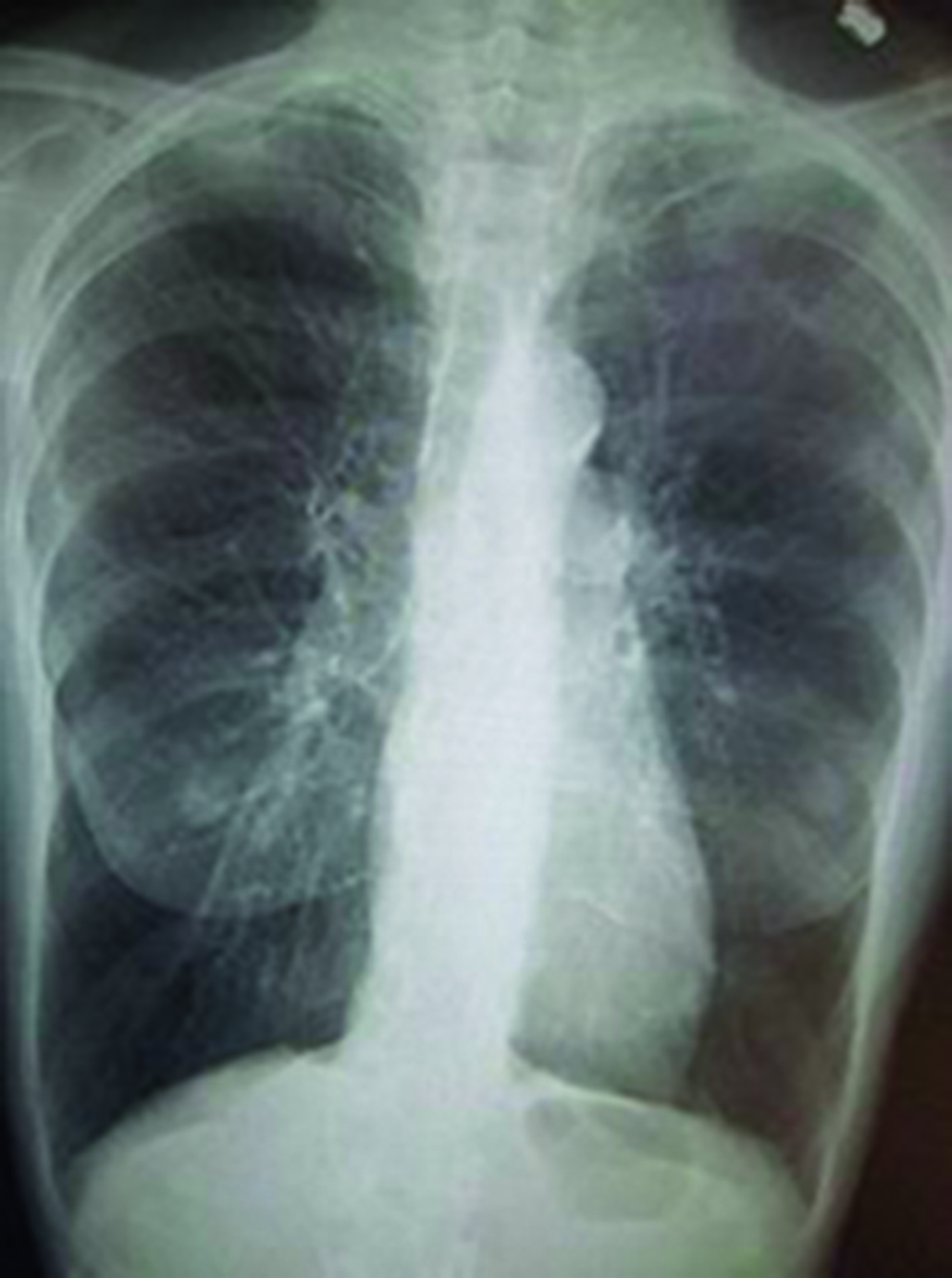 A Radiographie thoracique d’un patient emphysémateux (distension thoracique)