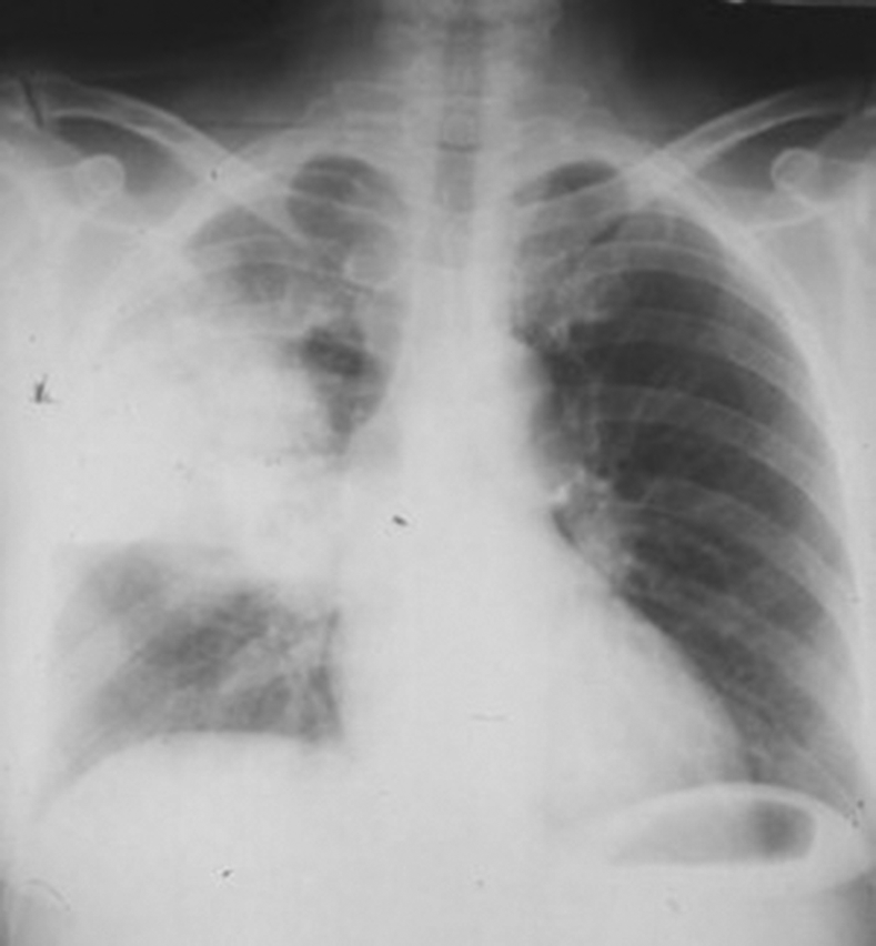 Radiographie thoracique de face du patient