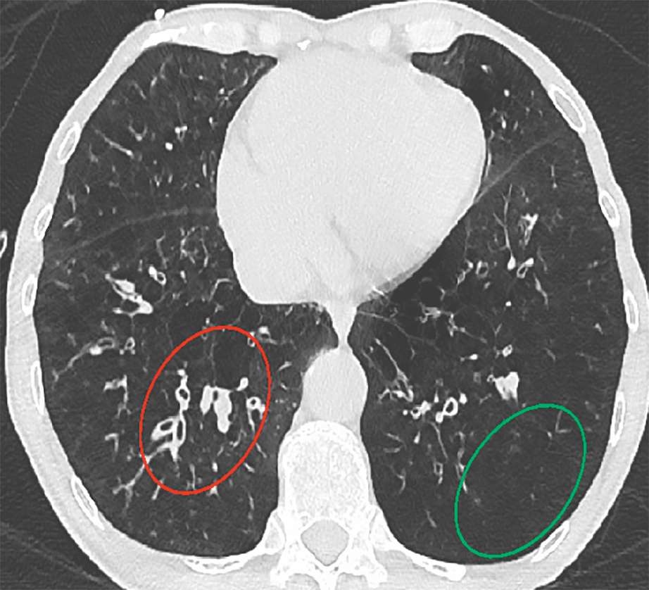 Coupe de scanner thoracique en fenêtre parenchymateuse, avec deux zones cerclées en rouge et en vert