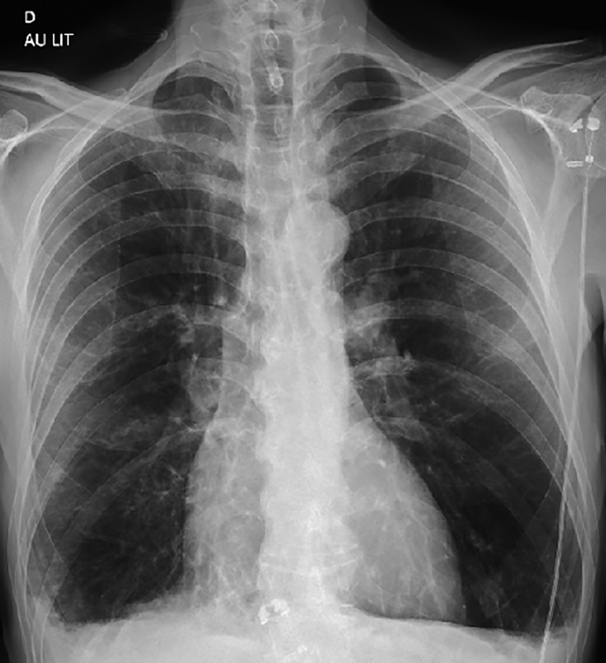 Radiographie thoracique de face du patient, réalisée au lit