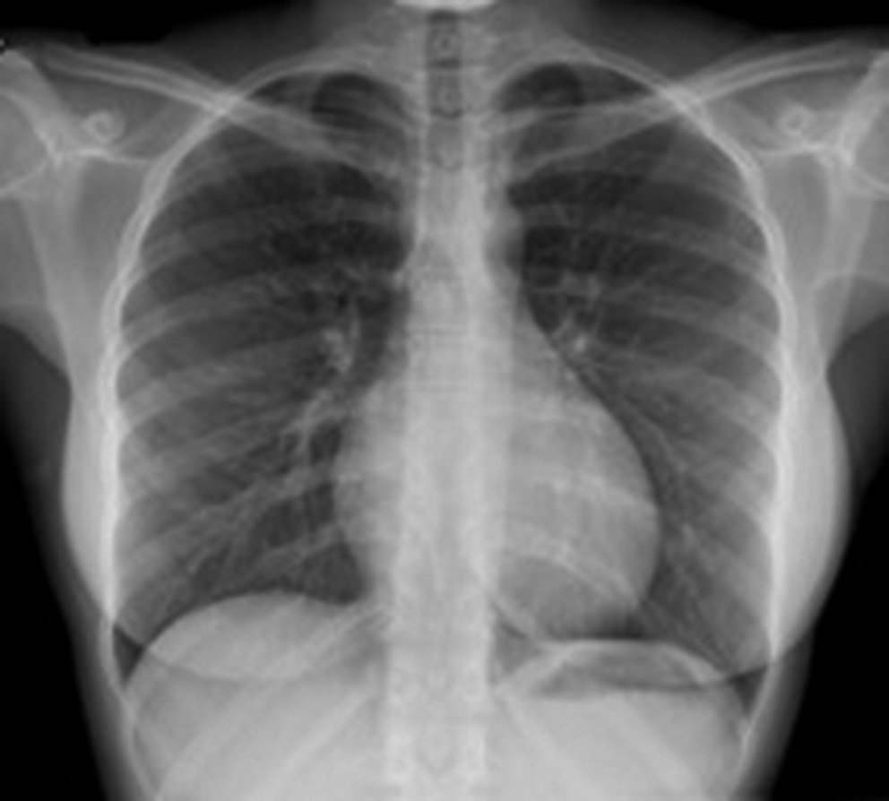 Radiographie thoracique de face du patient