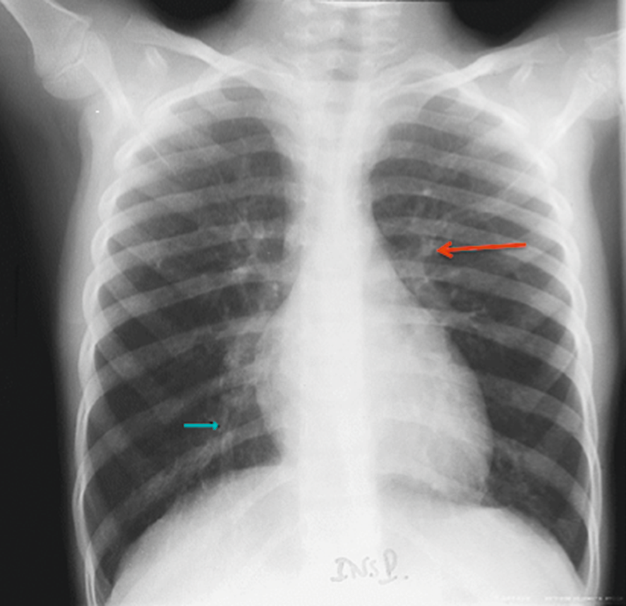 B Radiographie thoracique montrant des signes de distension thoracique chez un patient présentant une exacerbation d’asthme
