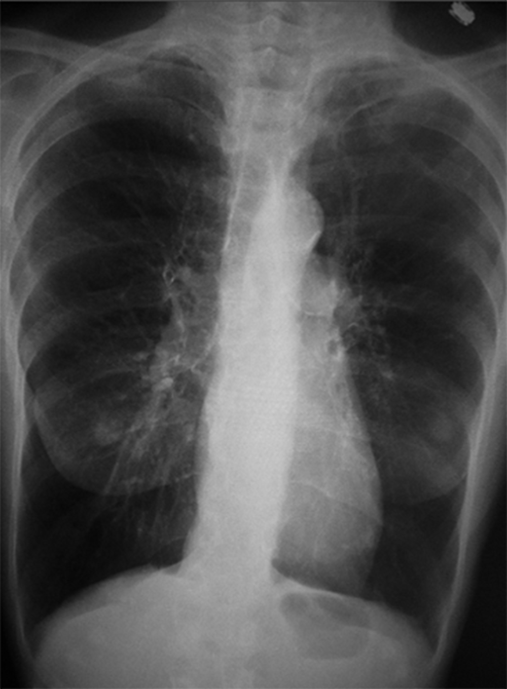 Radiographie thoracique de face de la patiente