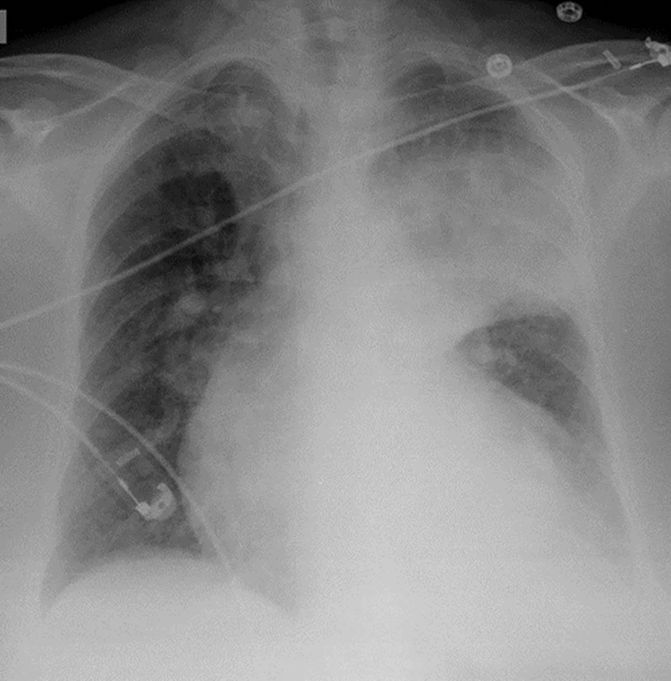 A Radiographie de pneumonie franche lobaire aiguë du lobe supérieur du poumon gauche (culmen)