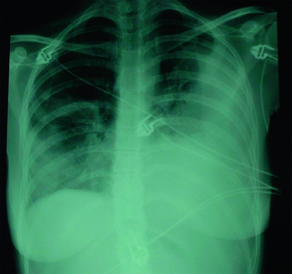 Radiographie thoracique de face au lit du patient, en incidence dos-plaque