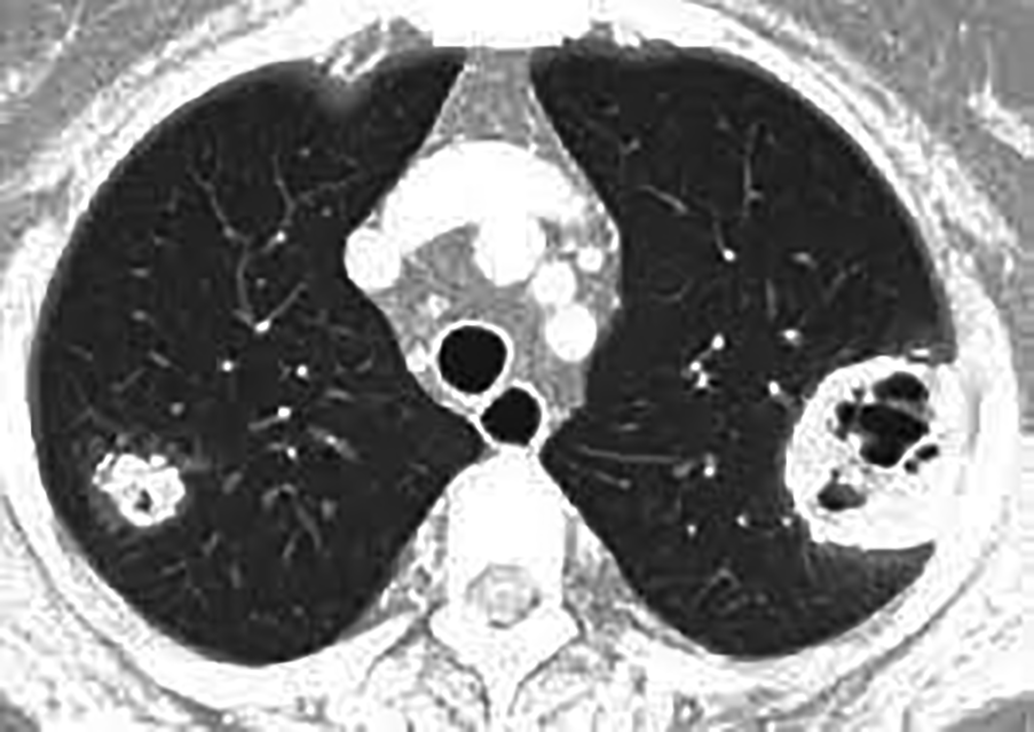 Coupe de scanner thoracique axiale en fenêtre parenchymateuse