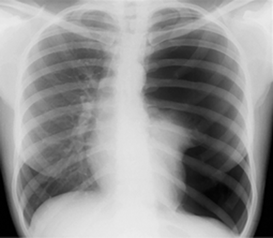 Radiographie thoracique de face du patient