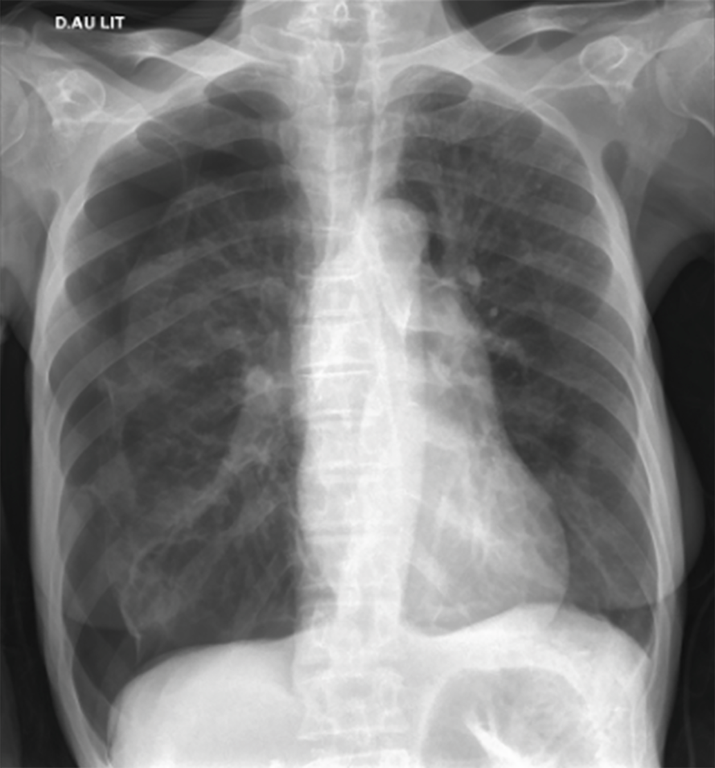 Radiographie thoracique de face du patient, réalisée au lit