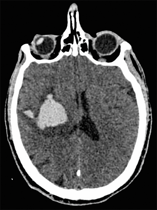 Coupe de scanner cérébral axiale sans injection de la patiente