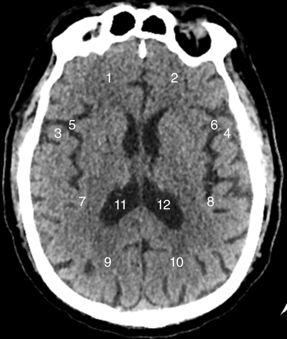 A Scanner cérébral en coupe horizontale au niveau de l’encéphale (coupe haute)