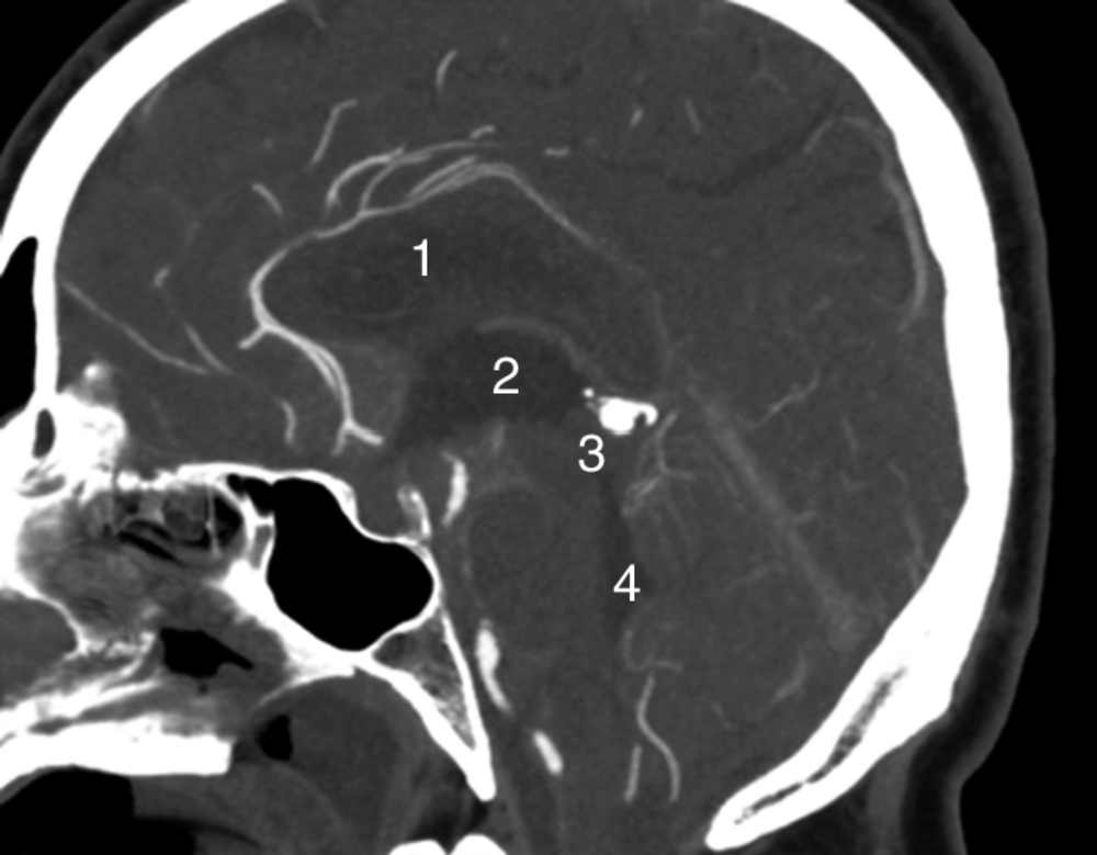 A Scanner cérébral injecté en coupe sagittale exposant le système ventriculaire