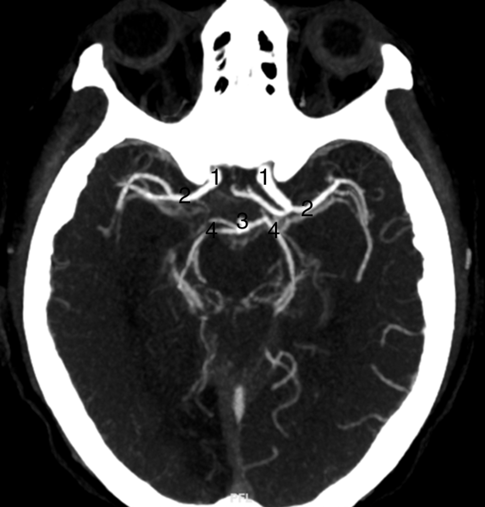 A Scanner cérébral injecté (temps artériel). Coupe axiale affichant une partie du polygone de Willis