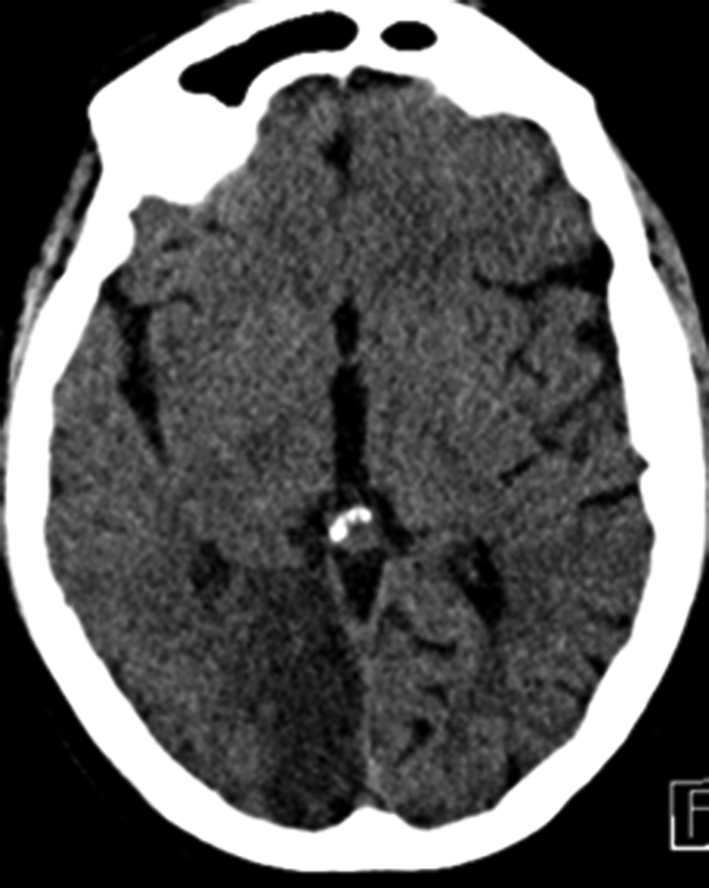 A Hypodensité occipitale droite systématisée au territoire de l’artère cérébrale postérieure droite. AVC ischémique responsable quelques jours auparavant d’une hémianopsie…
