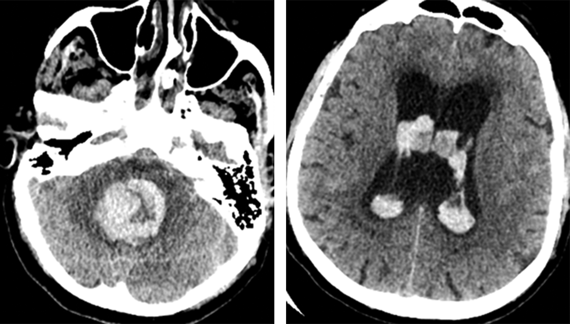 A Hématome cérébelleux responsable d’une compression du quatrième ventricule (à gauche). Dilatation des deux ventricules latéraux dans le cadre d’une hydrocéphalie aiguë