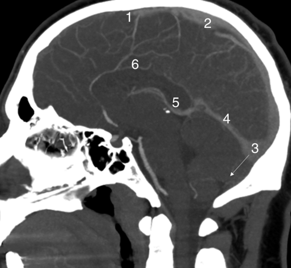 A Scanner cérébral injecté (temps veineux) en coupe sagittale