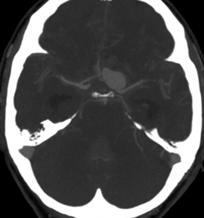 A Malformation vasculaire sacciforme développée aux dépens de l’artère cérébrale antérieure gauche. Anévrysme intracrânien responsable d’une hémorragie méningée affichée sur…